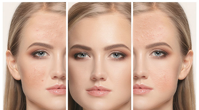 Jak usunąć blizny po trądziku?